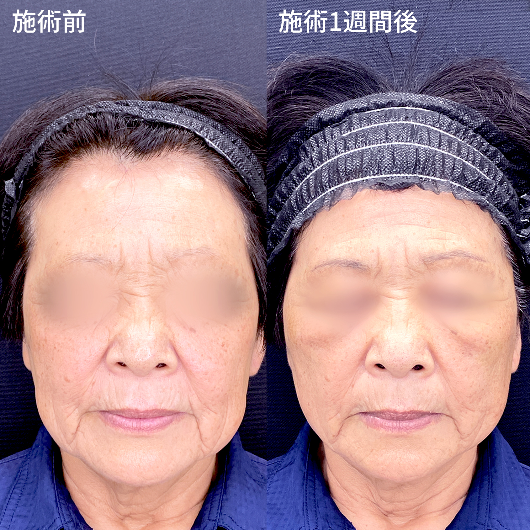 TAC式 ツヤ肌コラーゲンリフト®の症例写真 施術前後