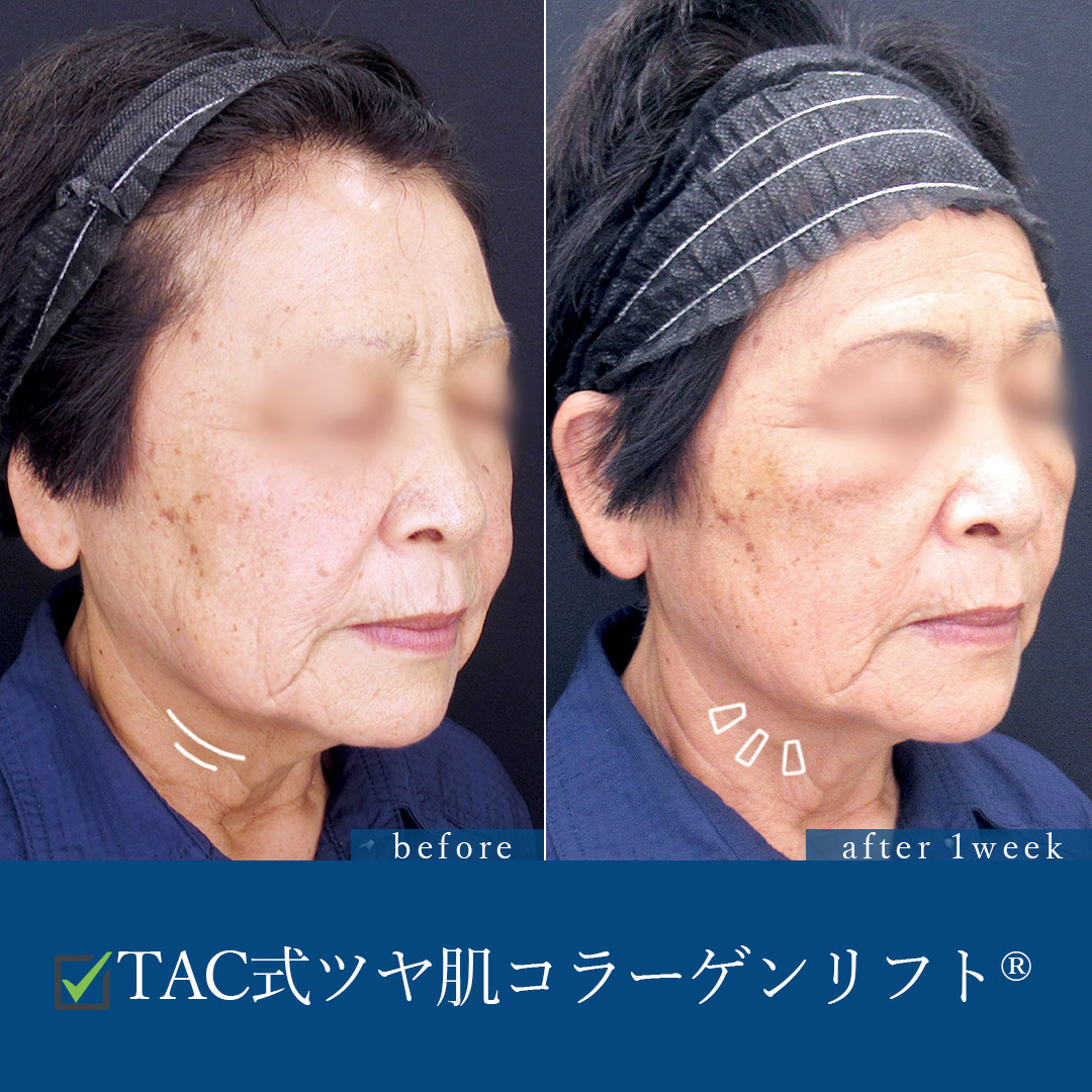 TAC式 ツヤ肌コラーゲンリフト®の症例写真 施術前後