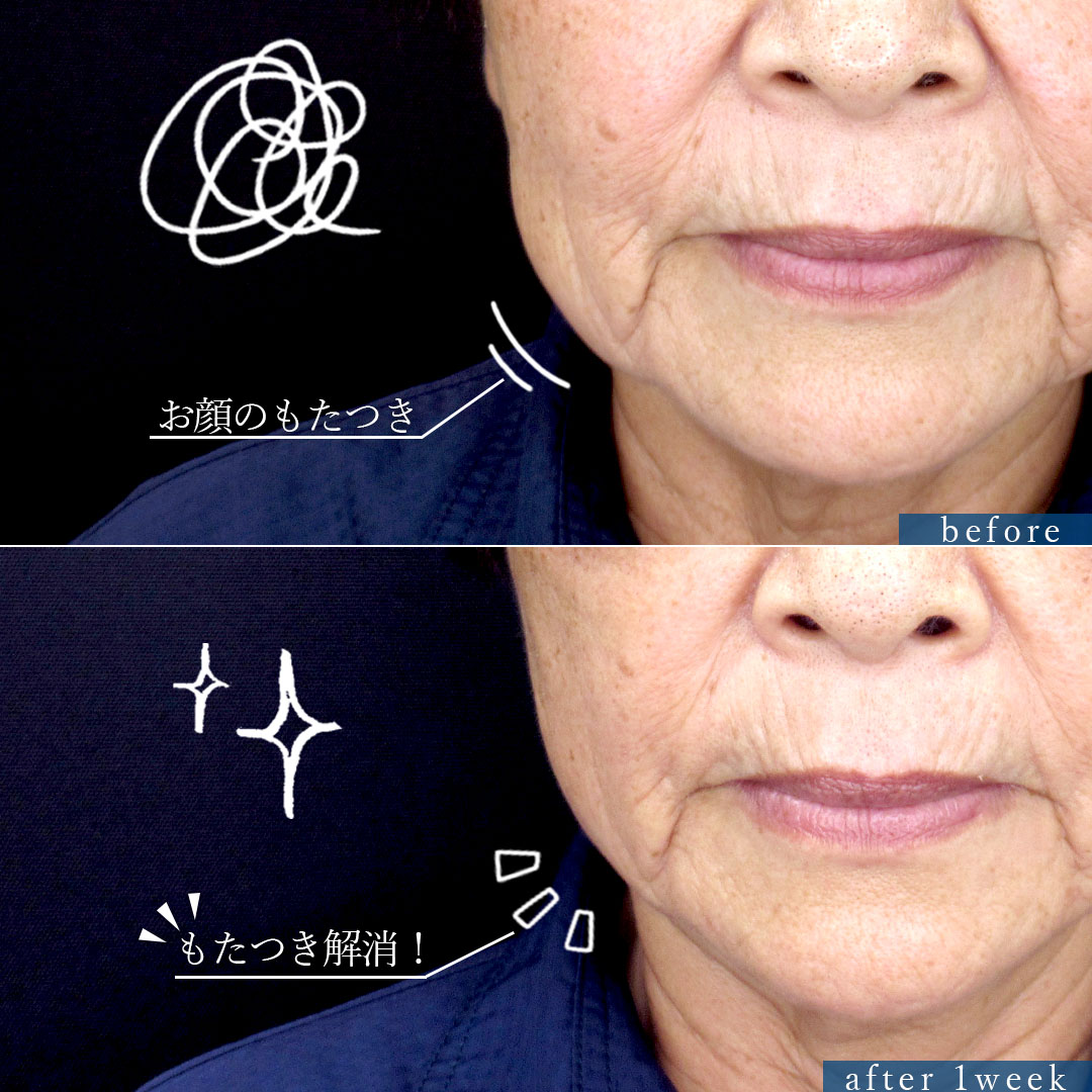 TAC式 ツヤ肌コラーゲンリフト®の症例写真 施術前後