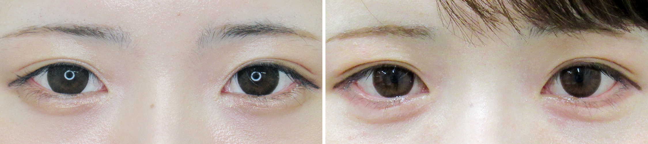 グラマラスライン、目尻切開術で愛されお目元に