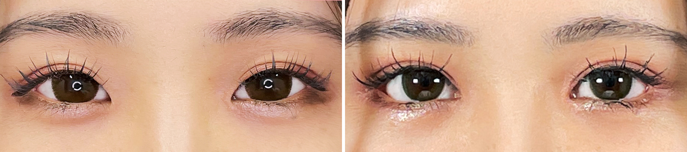 愛され度アップ！お目元の複合施術でかわいいタレ目に。