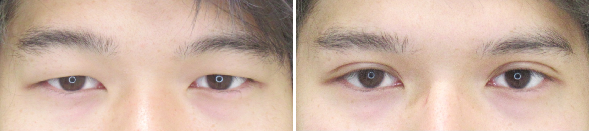 二重埋没法で印象ガラッとチェンジ！！