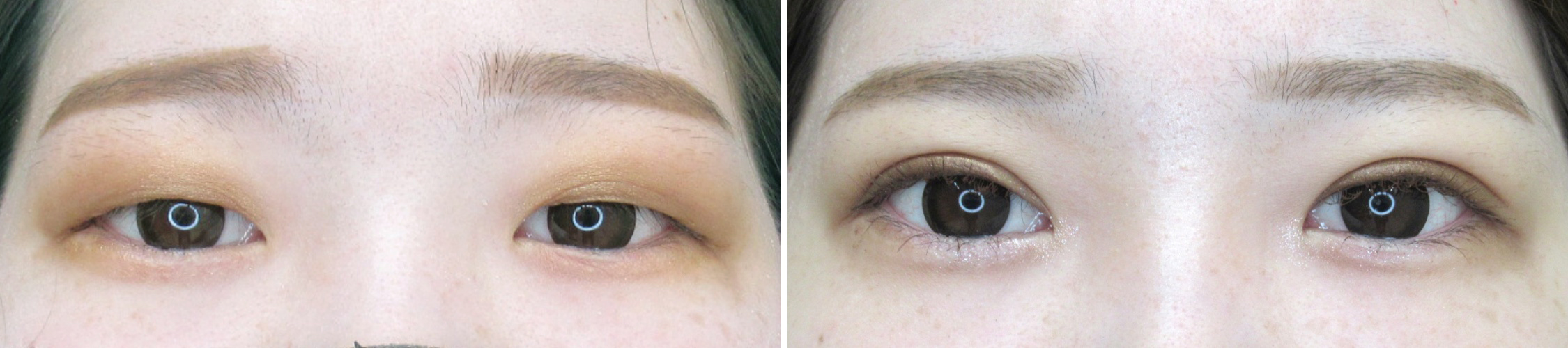 切開が難しくても埋没法でかわいい二重