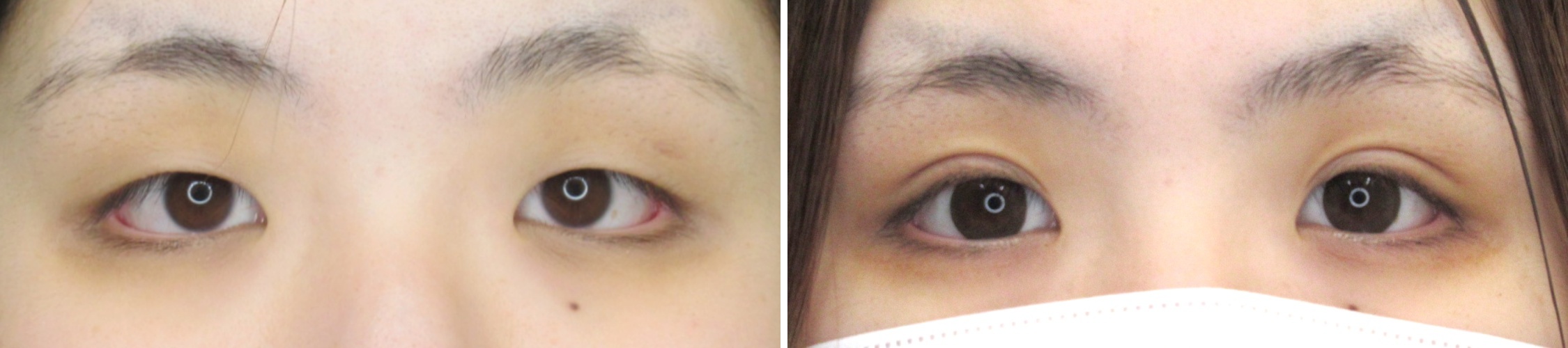 クイックコスメリングの症例写真 施術前後 1週間