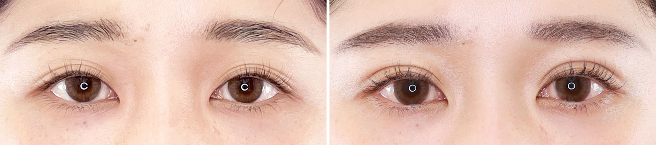 憧れのはっきり二重。ダウンタイムの少ないクイックコスメリング法！