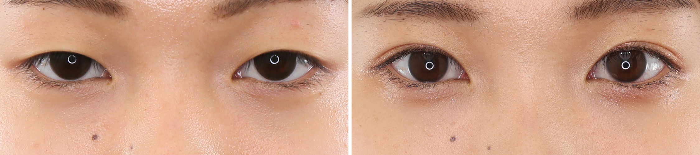 お手軽プチ整形で変わる、理想のお目元。