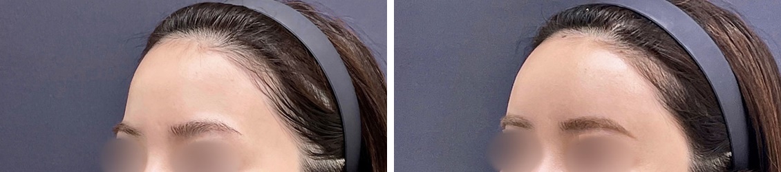 脂肪注入でおでこにナチュラルな丸みをもたせる