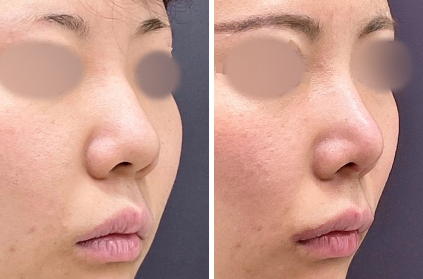 鼻尖形成と軟骨移植で 整形感を出さずやり過ぎない鼻整形