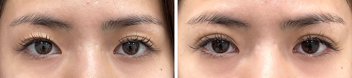 クイックコスメリングで目の左右差をナチュラルに整える