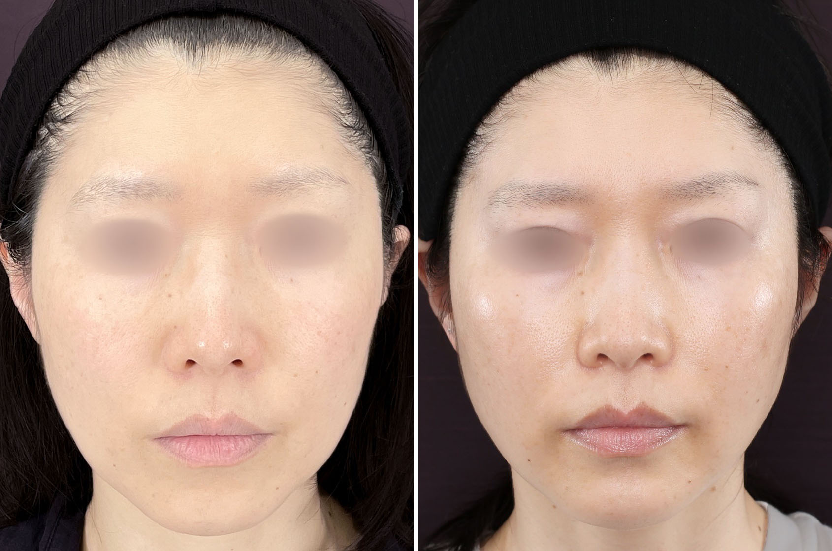 直後から実感できる！！TAC式ツヤ肌コラーゲンリフトのリフトアップ効果！！