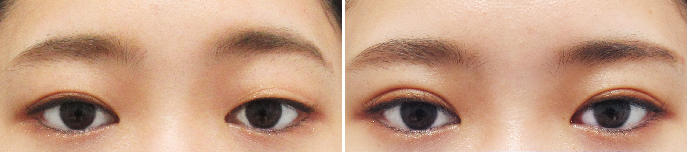 人気の高い埋没法で自然な二重に