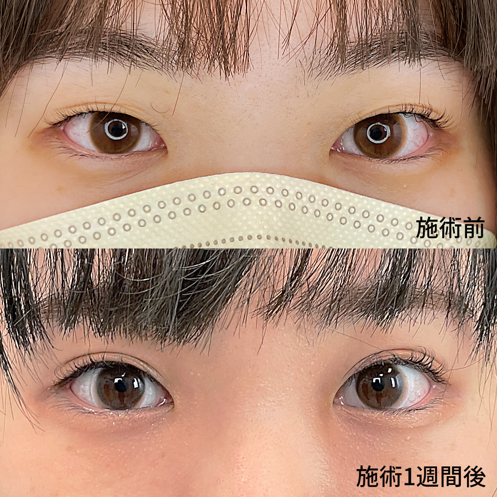 今っぽかわいい二重はTAクリニックで作れる★