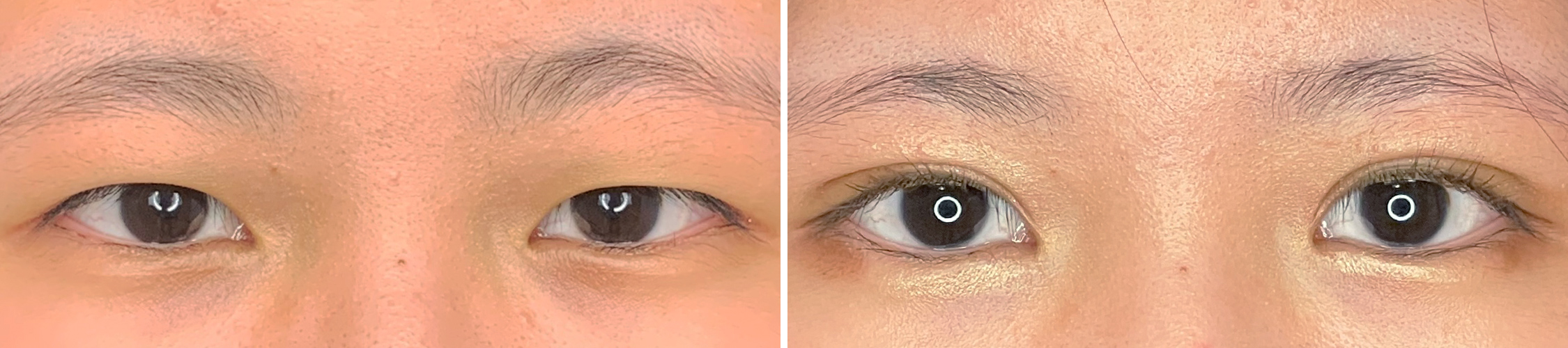 エターナル法でデザイン性と取れづらさを両立した二重をGET！