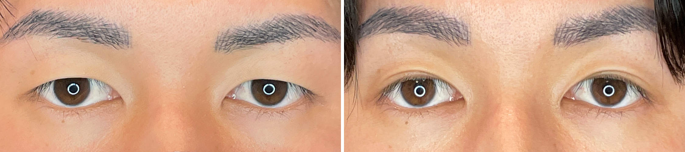 メンズのイケてる二重は横浜で手に入る★