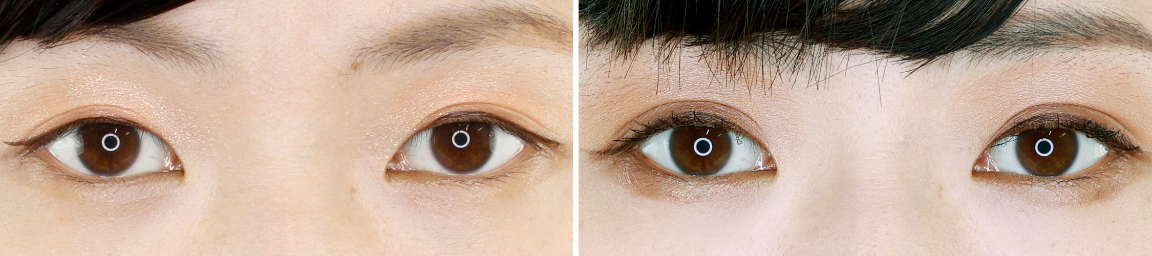 二重埋没法でくっきりキレイな二重ライン