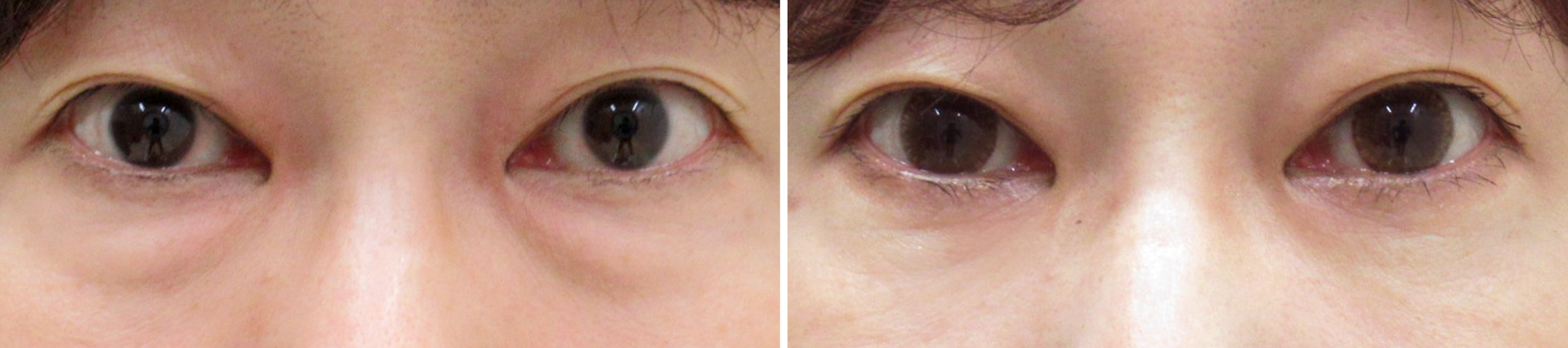 下眼瞼脱脂術で目の下のクマ改善