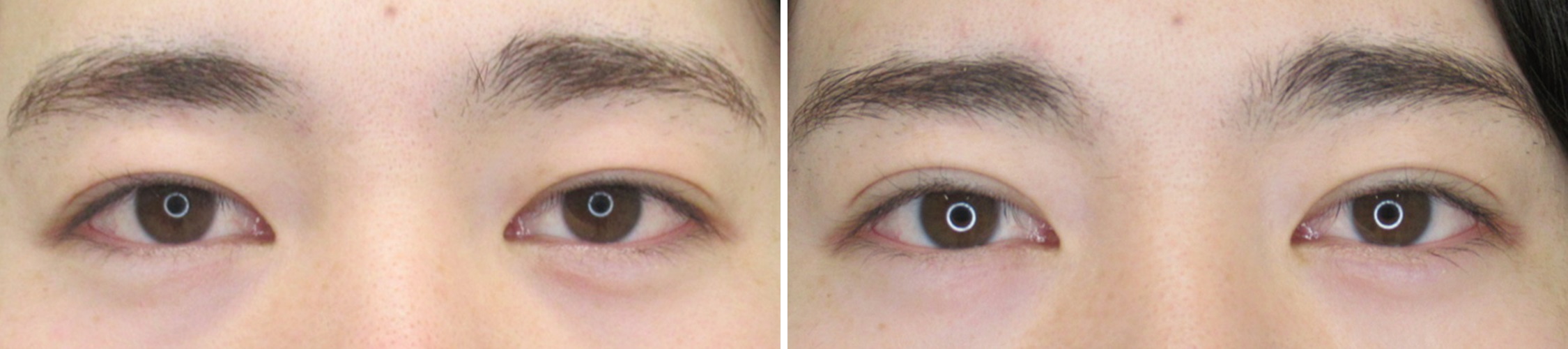 二重埋没法の症例写真 施術前後 １ヵ月