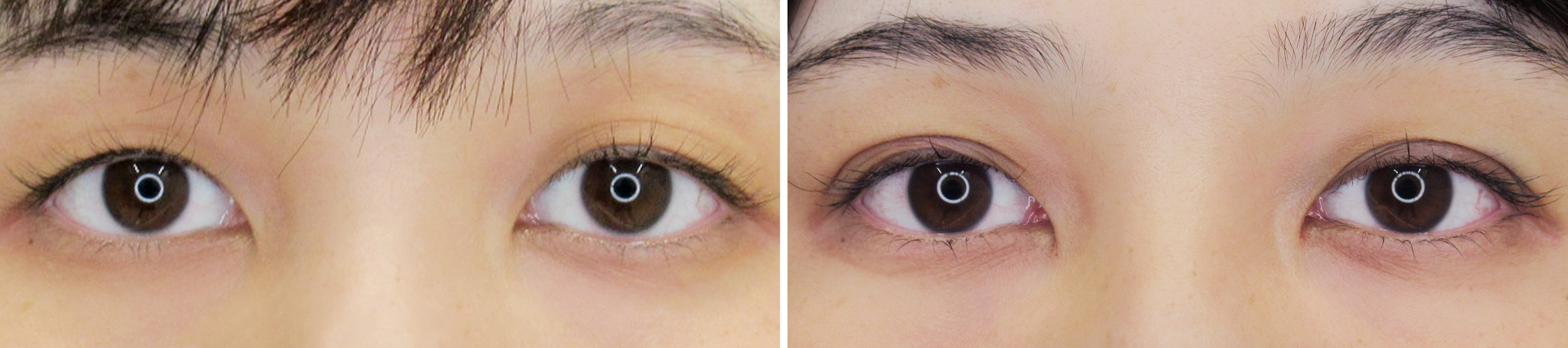 クイックコスメリングでなりたい二重をつくります