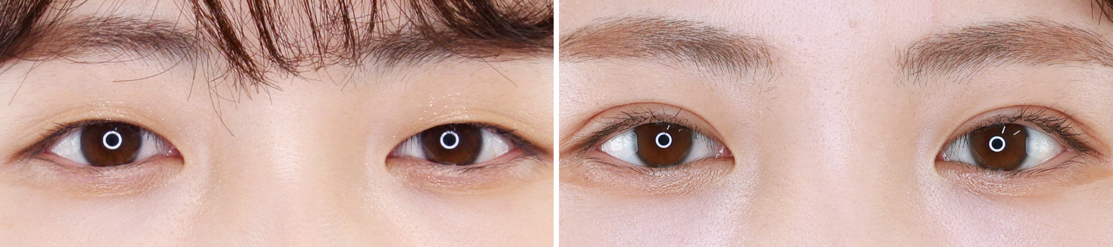 優しく可愛らしいお目元は埋没法で叶えます！