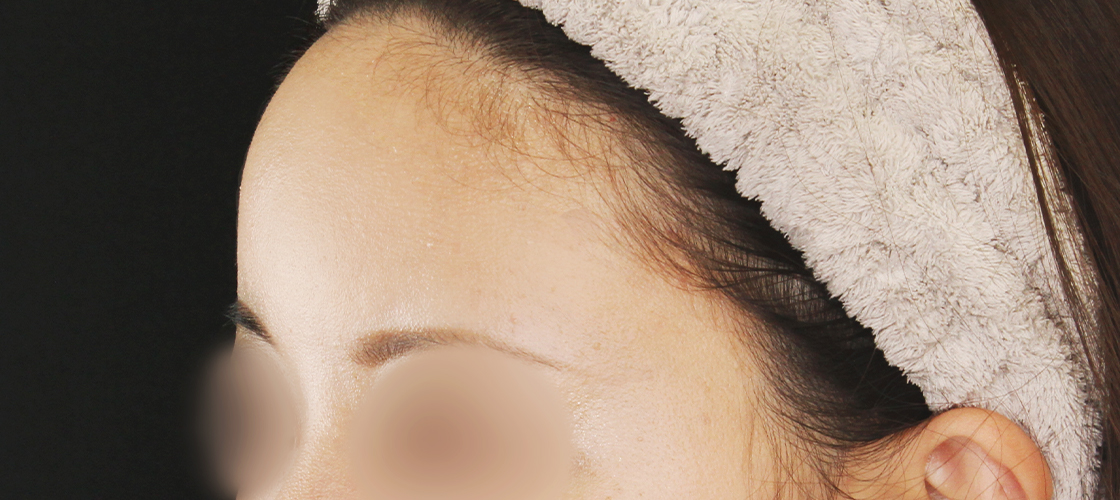 症例写真 ダウンタイム 丸いおでこでより女性らしいお顔立ちに Taクリニック 美容整形 美容外科 新宿 銀座 横浜 大阪 福岡 川越 高崎 Taクリニック 美容整形 美容外科
