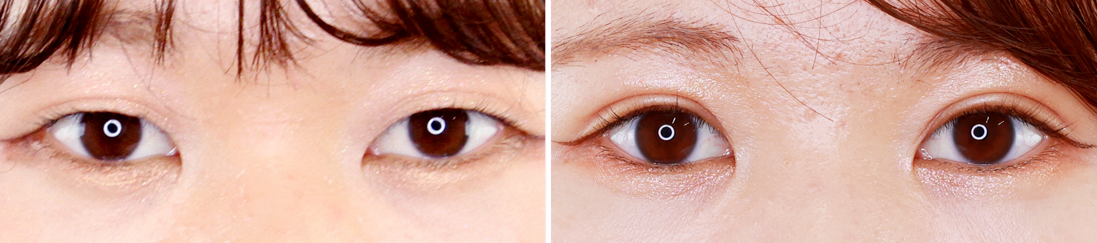 二重埋没法で薄い二重ラインをくっきりと