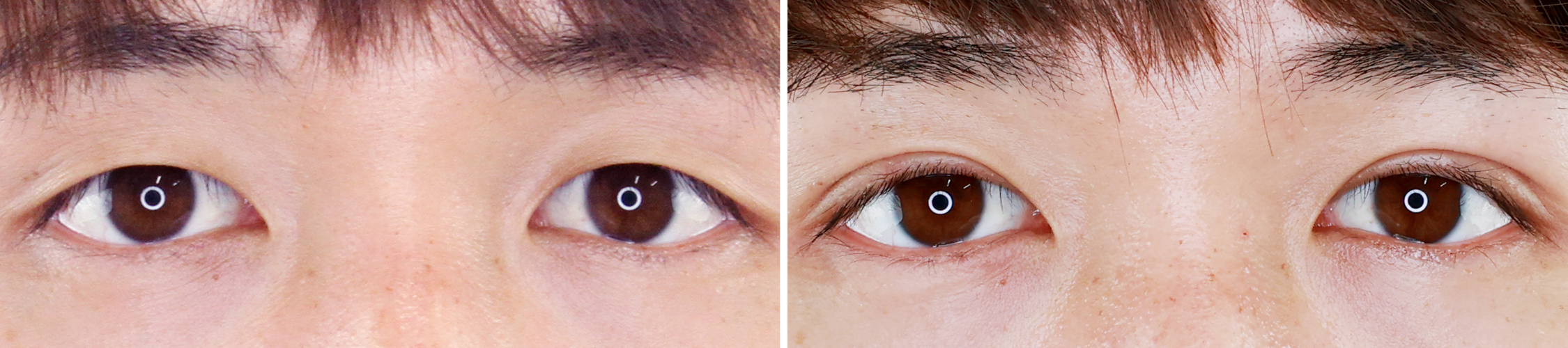 二重埋没法の症例写真 施術前後 1ヶ月