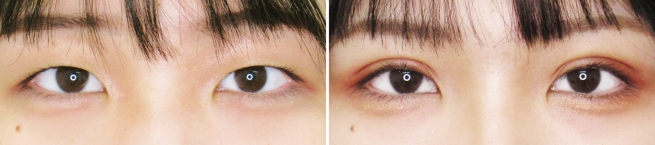 人気の二重埋没法でパッチリ二重に