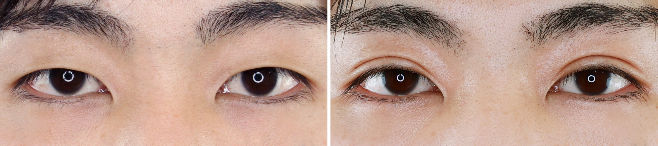 埋没法でメンズ二重もお好み通りのデザインに