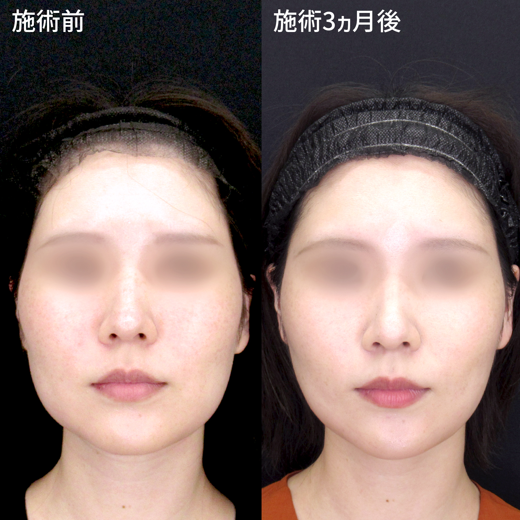 小顔整形Dr.志村 による糸リフト複合施術