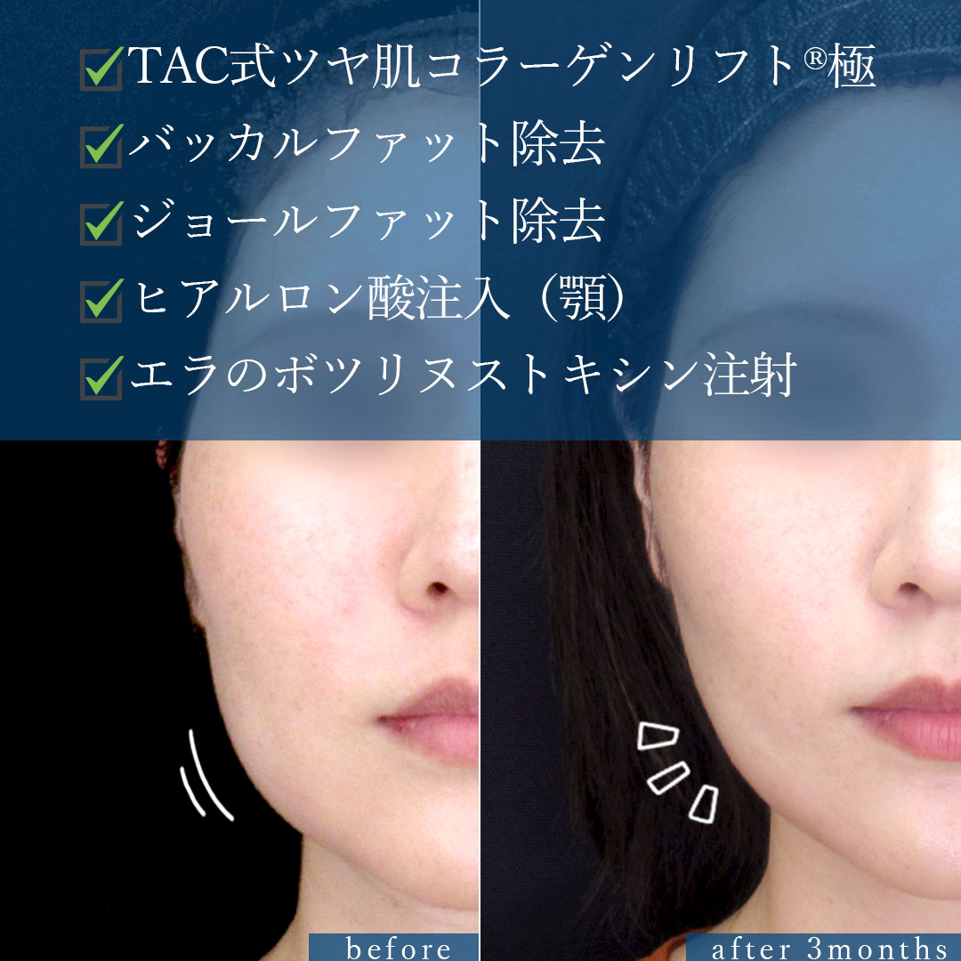 TAC式 ツヤ肌コラーゲンリフト®/バッカルファット除去/ジョールファット除去の症例写真 施術前後 