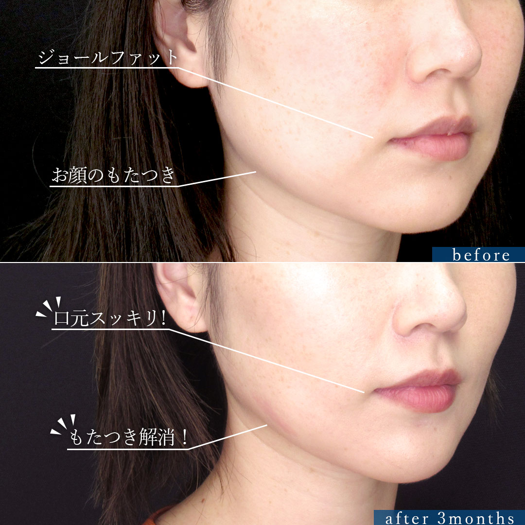 TAC式 ツヤ肌コラーゲンリフト®/バッカルファット除去/ジョールファット除去の症例写真 施術前後 