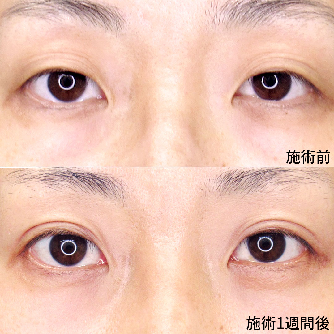 二重埋没法/下眼瞼脱脂術(目の下のたるみ取り・目の下の脂肪ふくらみ取り)の症例写真 施術前後