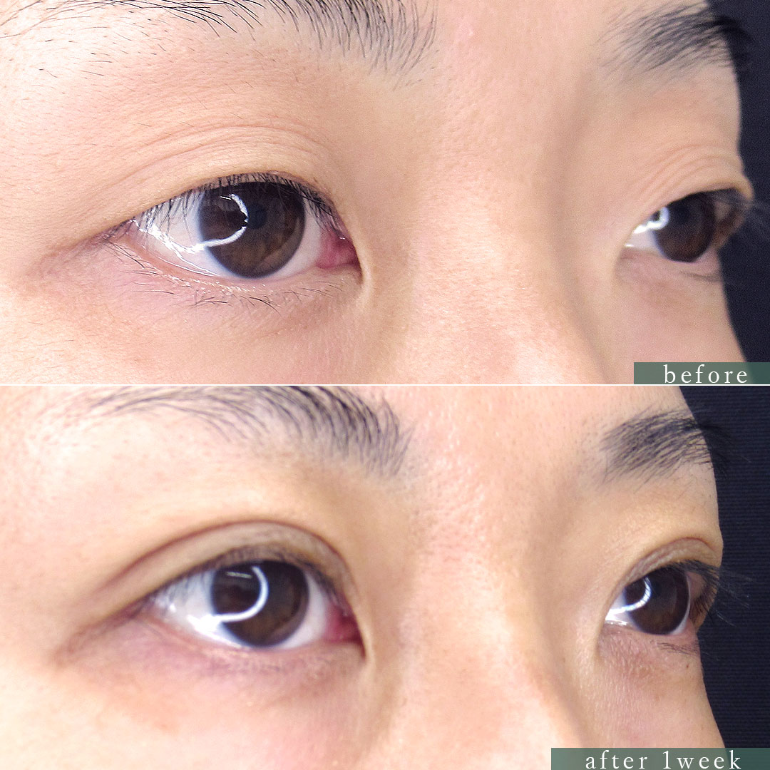 二重埋没法/下眼瞼脱脂術(目の下のたるみ取り・目の下の脂肪ふくらみ取り)の症例写真 施術前後