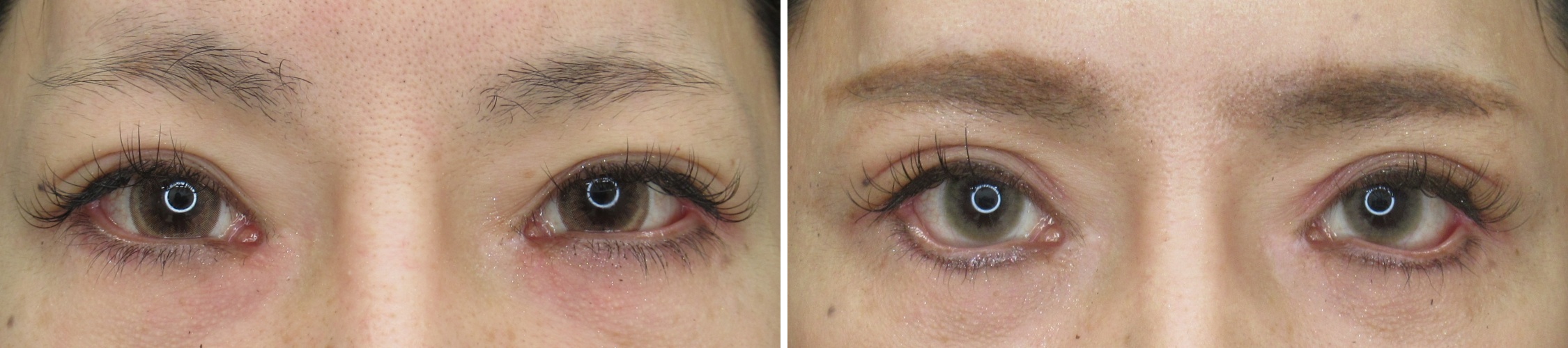 お目元の複合施術で目を最大限に大きく