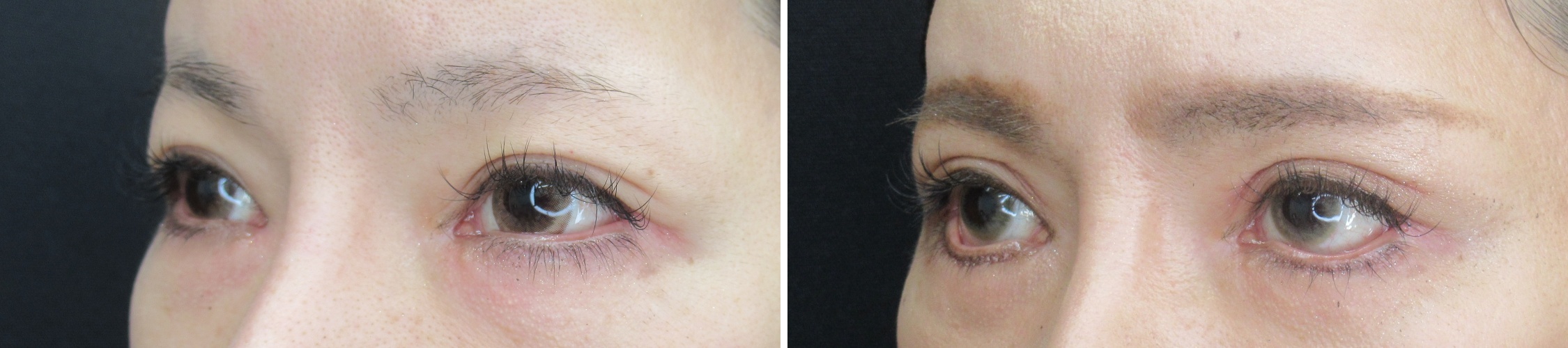 上眼瞼切開術/目尻切開術/グラマラスライン（タレ目形成）の症例写真 施術前後 １ヵ月