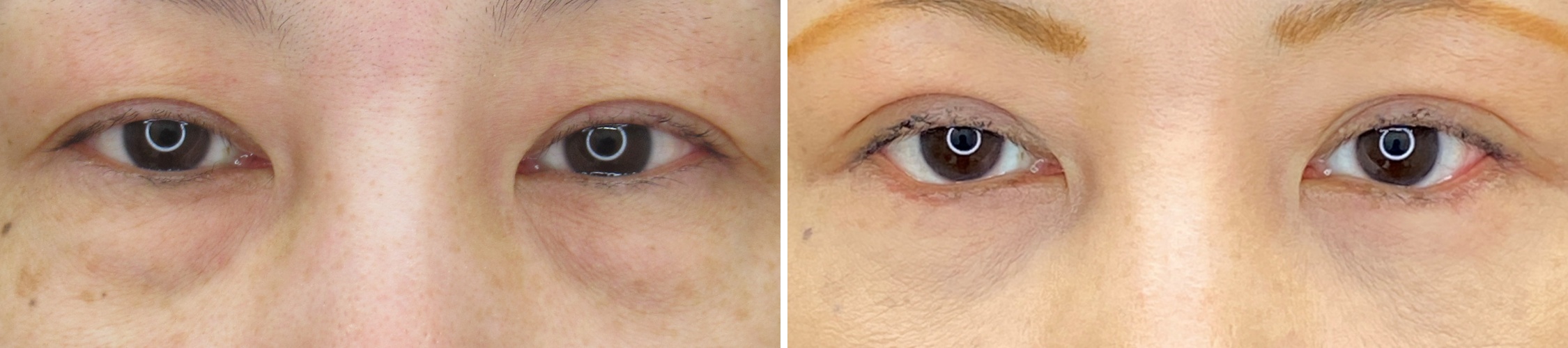 複合施術で華やかで若々しいお目元へ