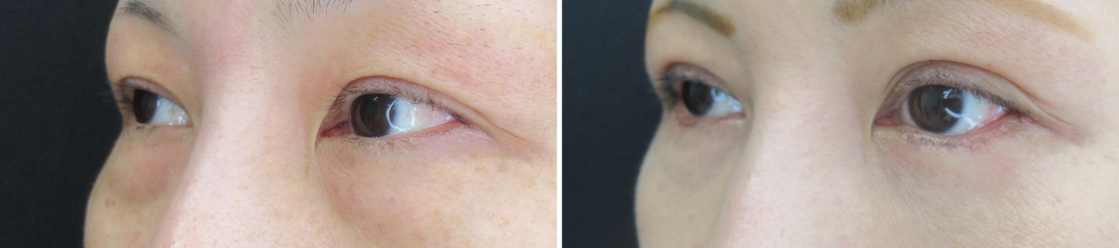 二重埋没法/目尻切開術/グラマラスライン（タレ目形成）の症例写真 施術前後 １ヵ月