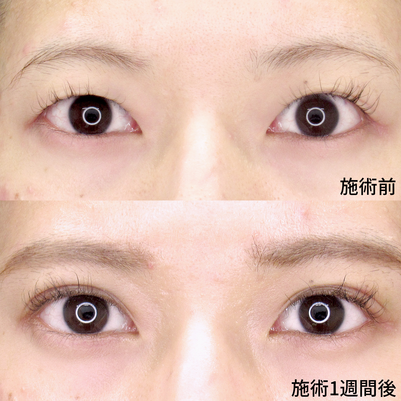 二重埋没法/目元:その他の症例写真 施術前後