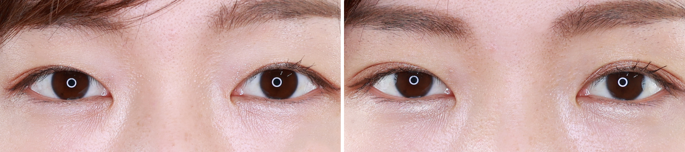 腫れにくい埋没法ならクイックコスメリング