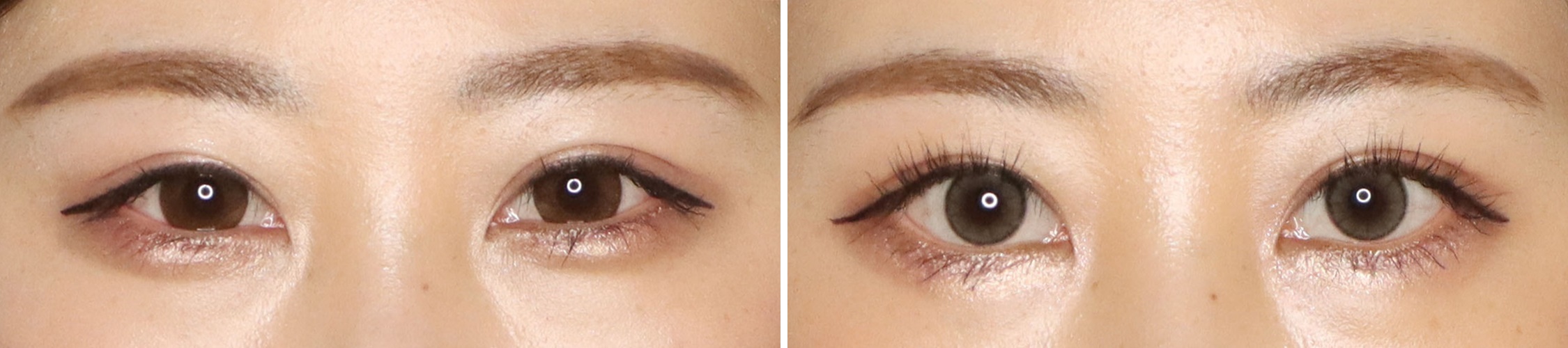 優しい表情で女子力アップ！自然なたれ目整形