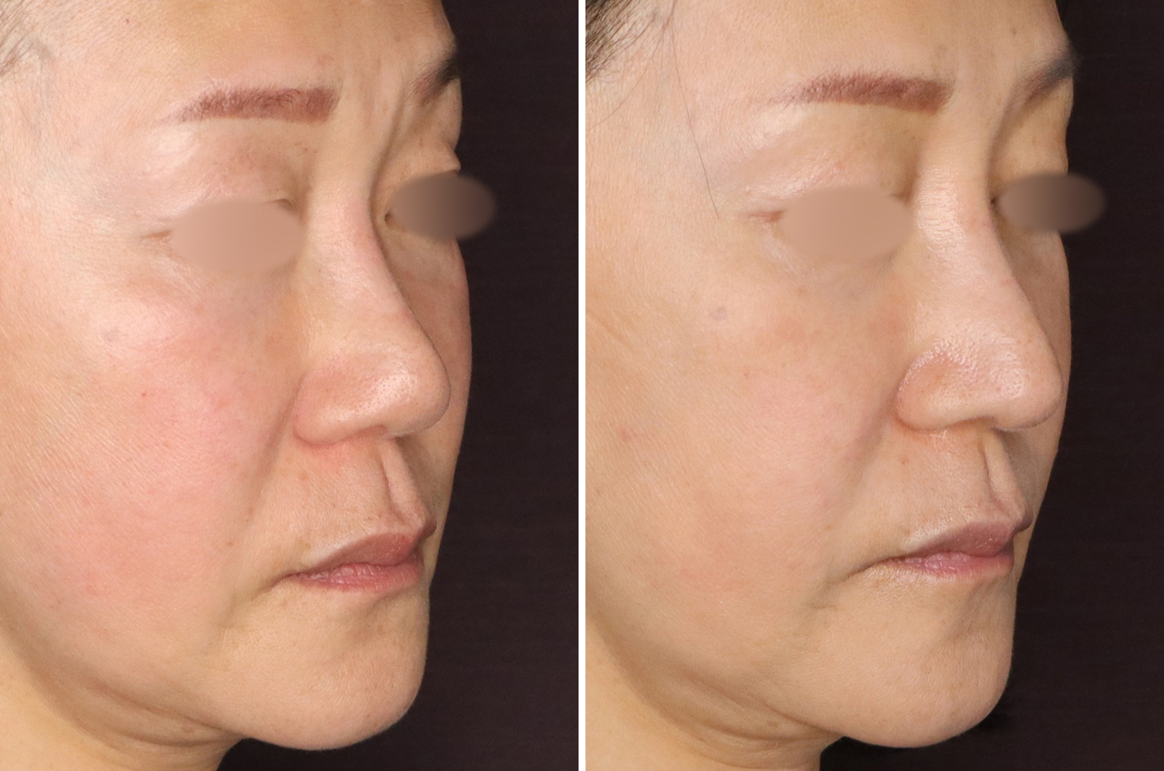 鼻中隔延長術で鼻を長く、鼻先もシャープに
