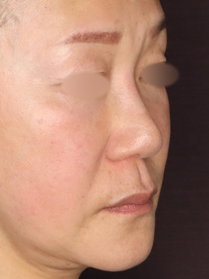 症例写真 ダウンタイム 鼻中隔延長術で鼻を長く 鼻先もシャープに Taクリニック 美容整形 美容外科 新宿 銀座 横浜 大阪 福岡 川越 高崎 Taクリニック 美容整形 美容外科