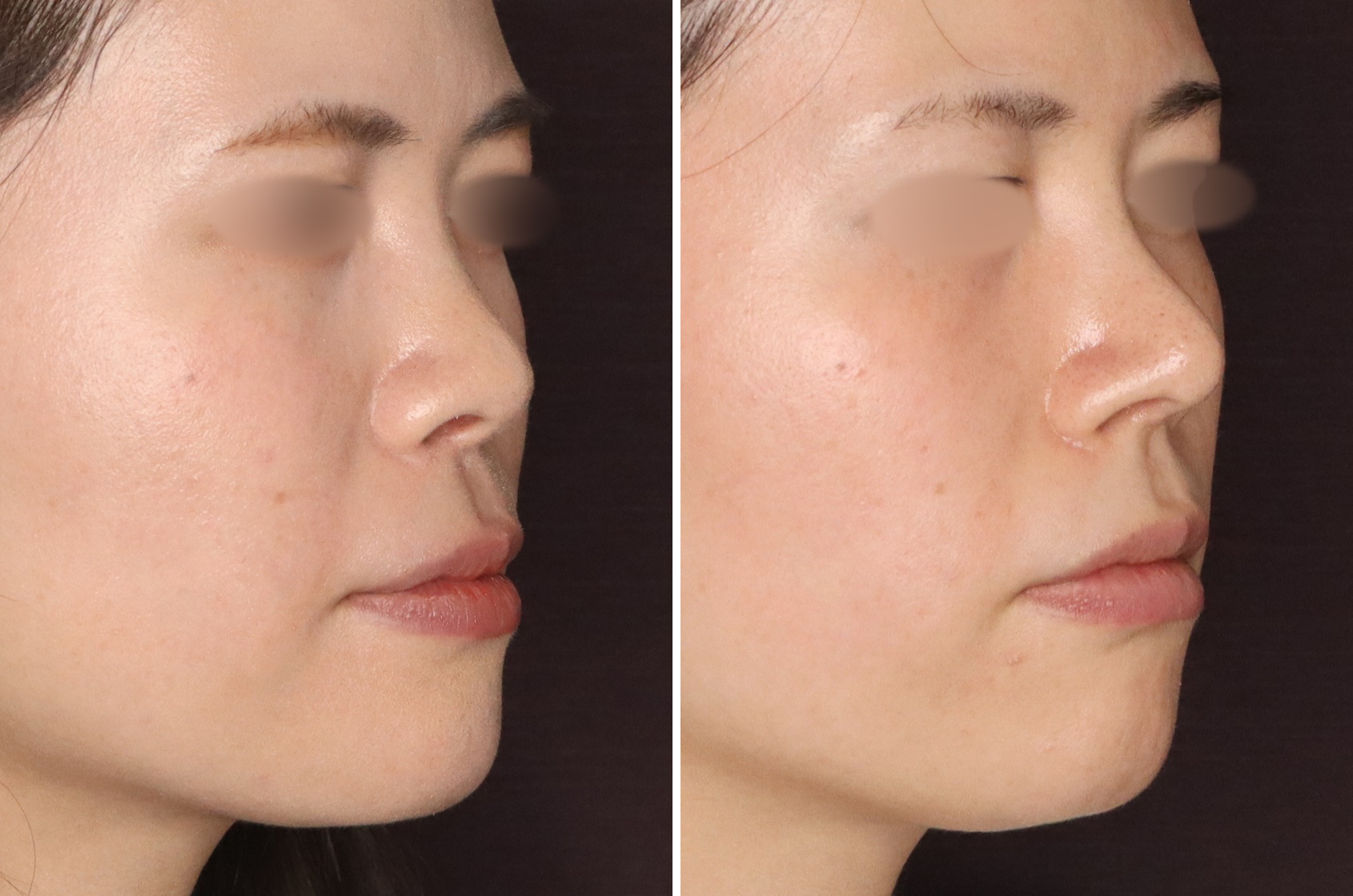 鼻を高く、長く見せる～鼻中隔延長術と軟骨移植と鼻尖形成～