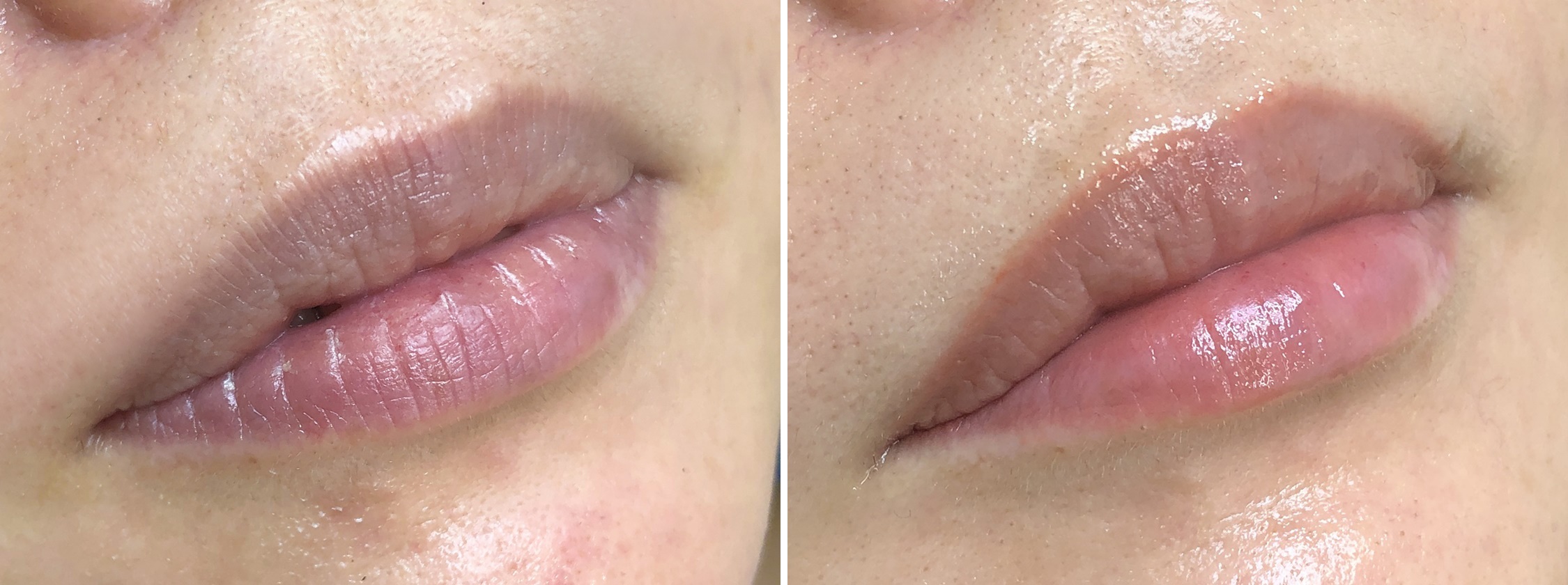 TACメディカルアートメイク（眉・アイライン・リップ）の症例写真 施術前後 1回目施術後1ヵ月