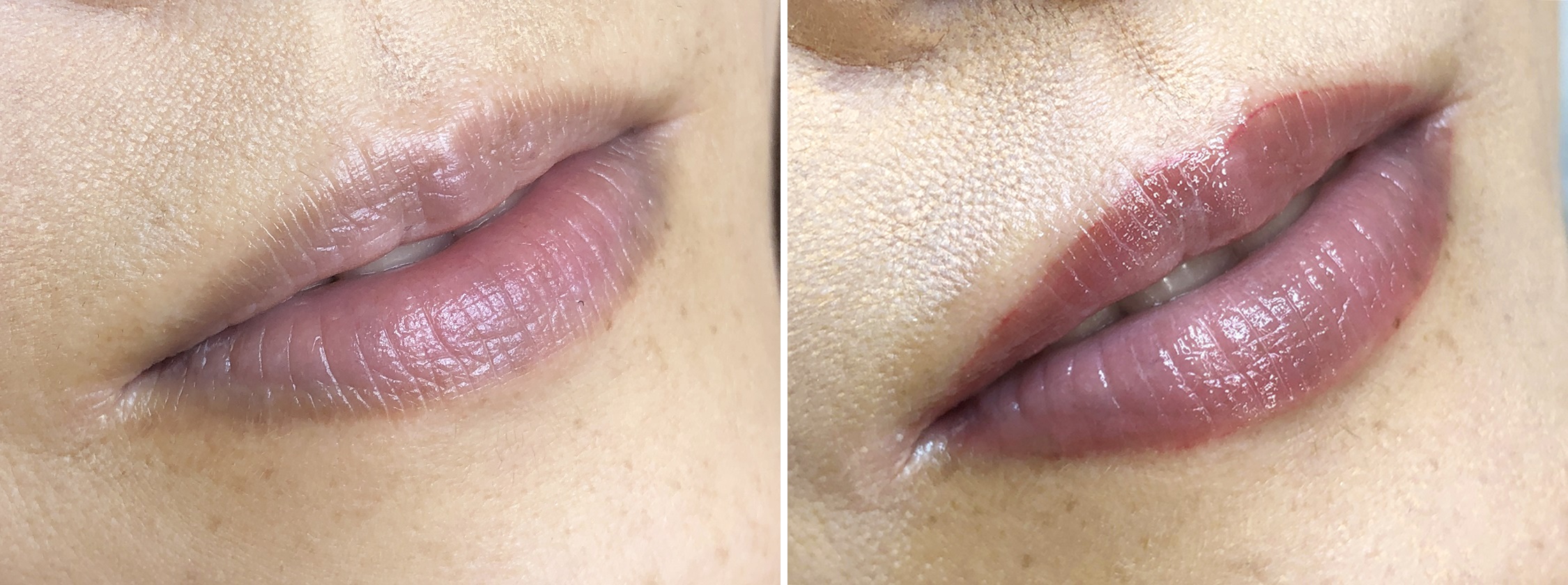 TACメディカルアートメイク（眉・アイライン・リップ）の症例写真 施術前後 1回目施術1か月後