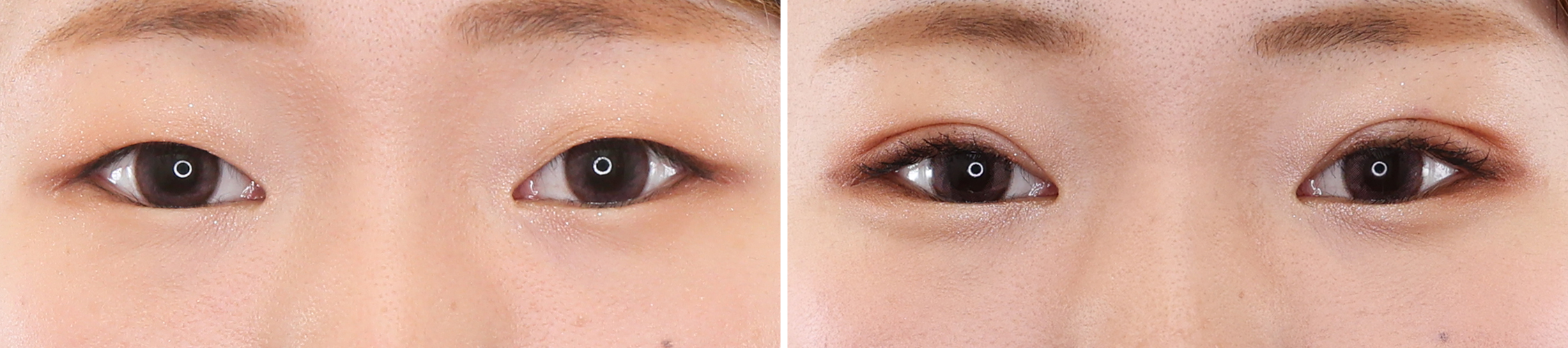 二重埋没法の症例写真 施術前後 10日