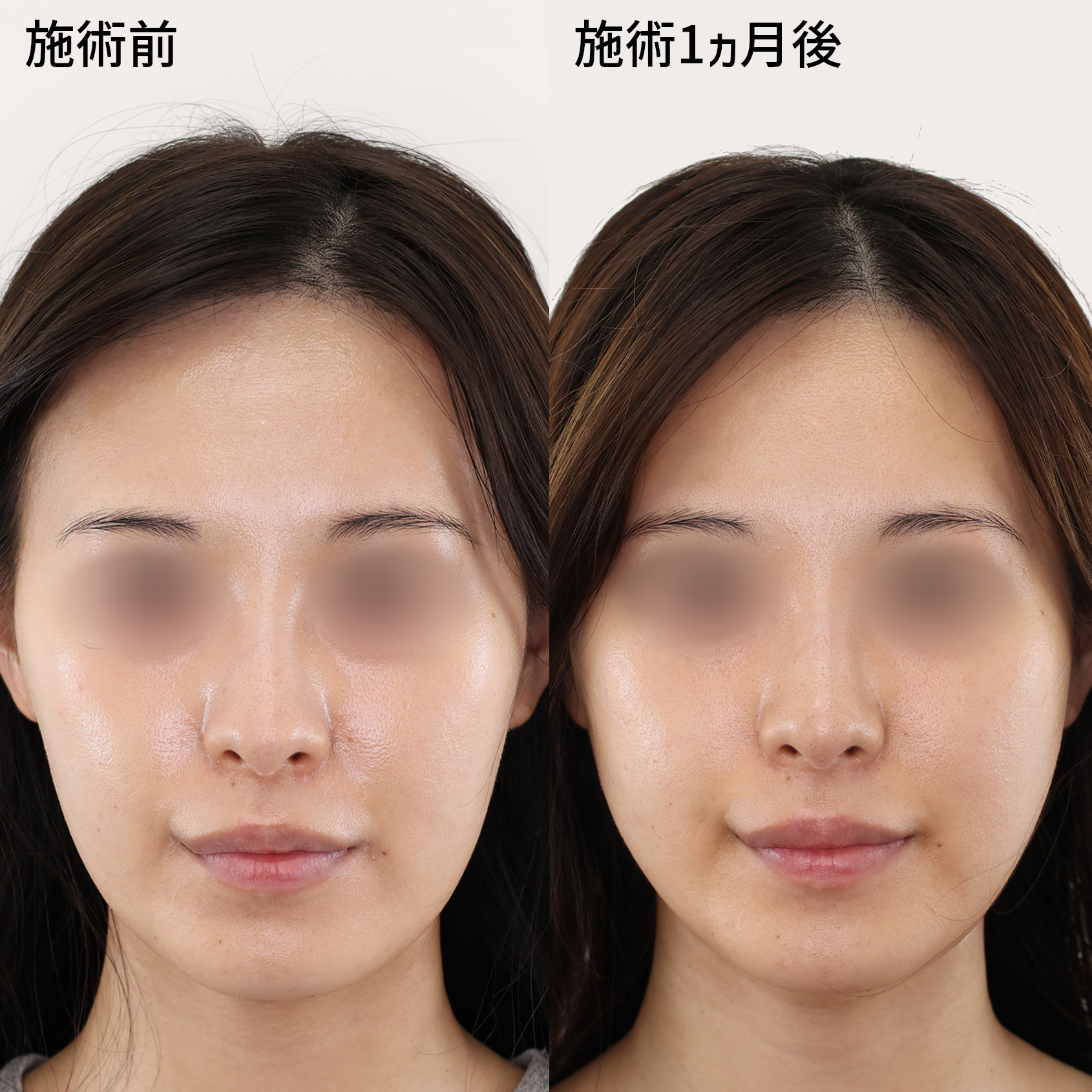 TAC式 ツヤ肌コラーゲンリフト®の症例写真 施術前後 