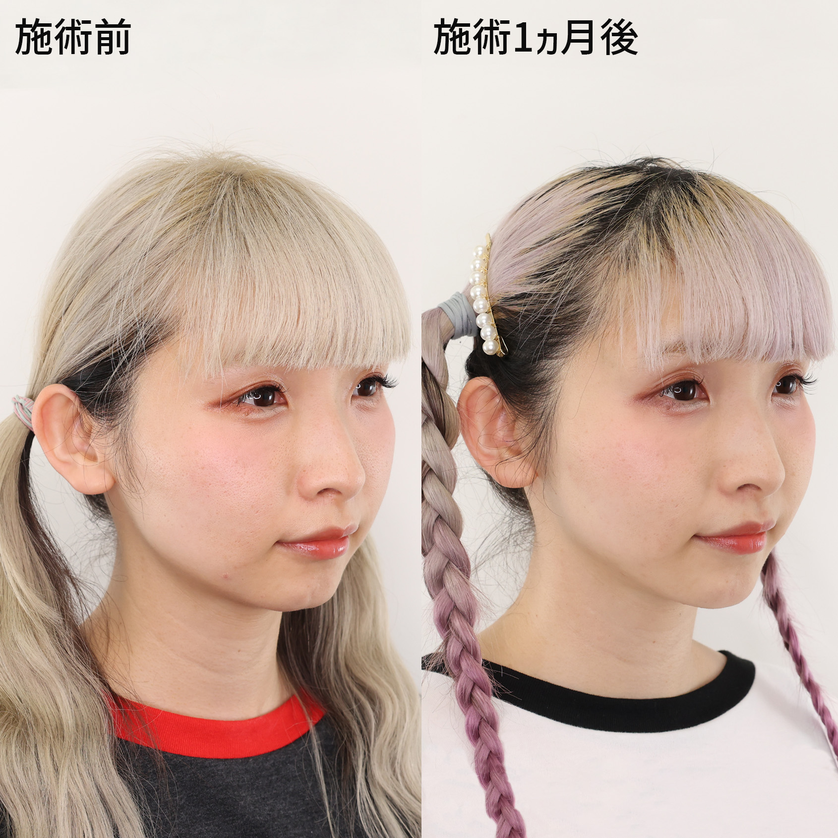 ジョールファット除去/TAC式 ツヤ肌コラーゲンリフト®/顎のヒアルロン酸注射の症例写真 施術前後 1ヵ月