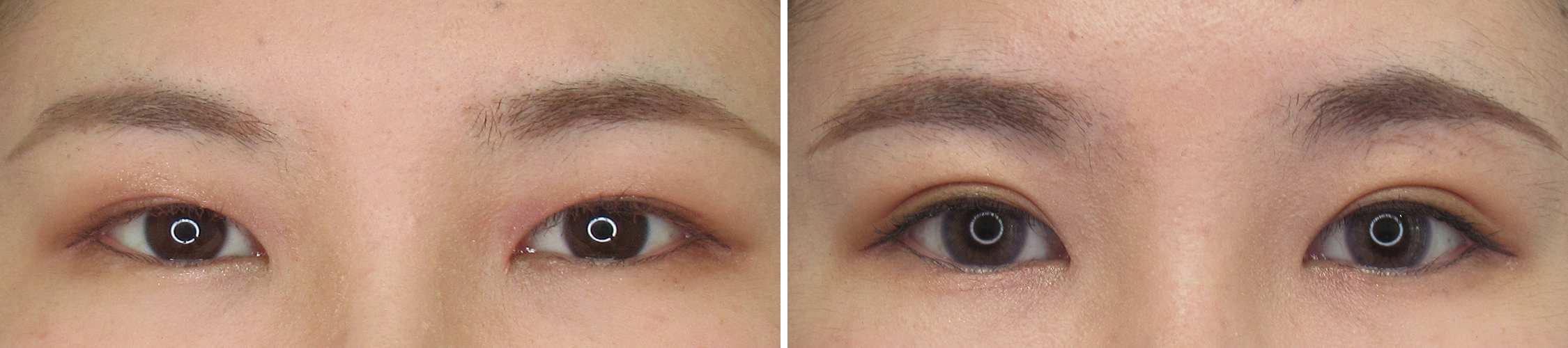 短めのダウンタイムで理想の二重に