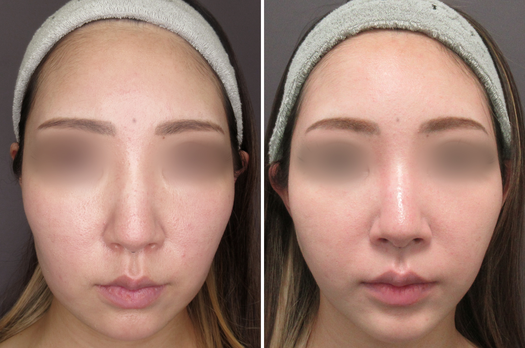 お顔のもたつきもスッキリさせて輪郭を出す